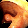 Colon Polyp